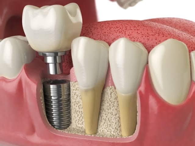 Çene kemiğine yerleştirilen diş implantının gösterimi