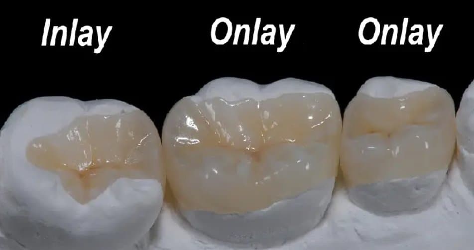 Laboratuvarda hazırlanan inley ve onley seramik dolgular