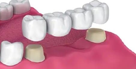 Diş köprüsünün eksik dişin yerine yerleştirilmiş görünümü